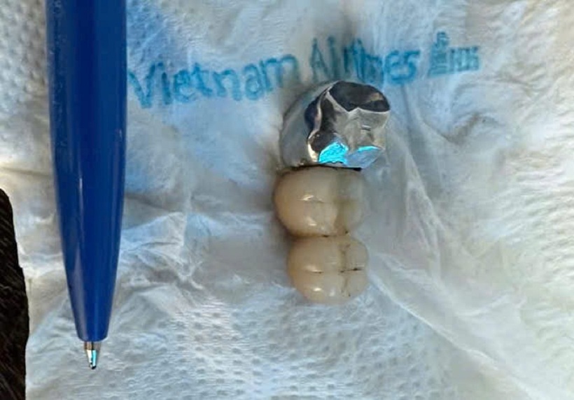 Dị vật sau khi được bác sĩ lấy ra. Ảnh: Bệnh viện Đa khoa tỉnh Bắc Giang