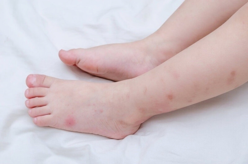 Bé trai khởi phát bệnh ngày 17/10 với triệu chứng sốt cao, nôn trớ, phát ban dạng chấm li ti toàn thân. Ảnh minh họa: Shutterstock