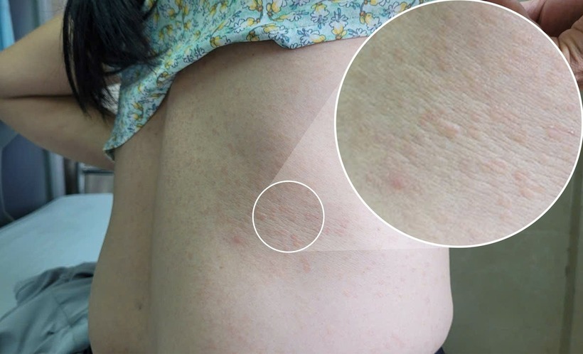 Hình ảnh vết mẩn ngứa do giun đũa trên cơ thể người phụ nữ. Ảnh: Tạp chí Tri Thức