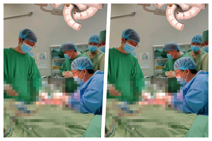 Các bác sĩ nhiều chuyên khoa của bệnh viện phẫu thuật cấp cứu khẩn cấp, nối thành công cánh tay cho nam bệnh nhân. Ảnh: Bệnh viện Đa khoa TP.Cần Thơ