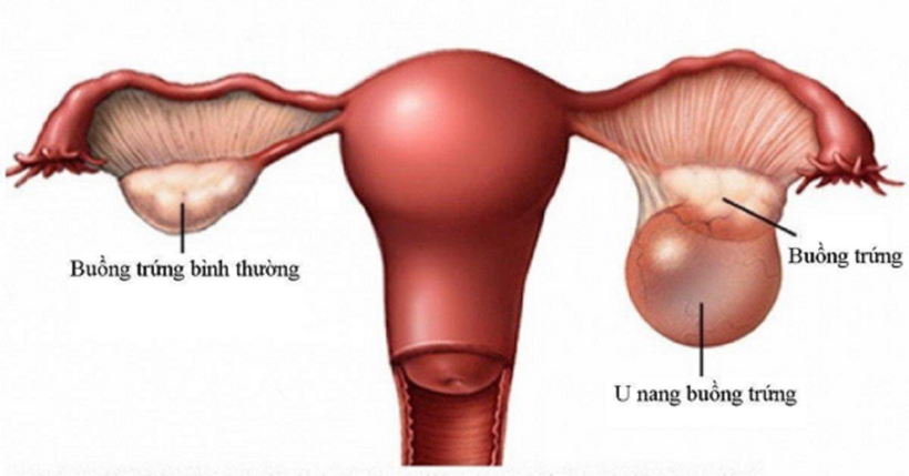 U nang buồng trứng ảnh hưởng rất lớn đến sức khỏe, chất lượng cuộc sống của người bệnh