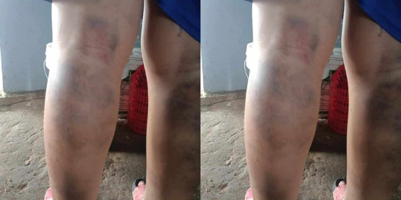 Hình ảnh 2 chân học sinh bị đánh bấm tim đăng lên mạng xã hội. Ảnh: Đại Đoàn Kết