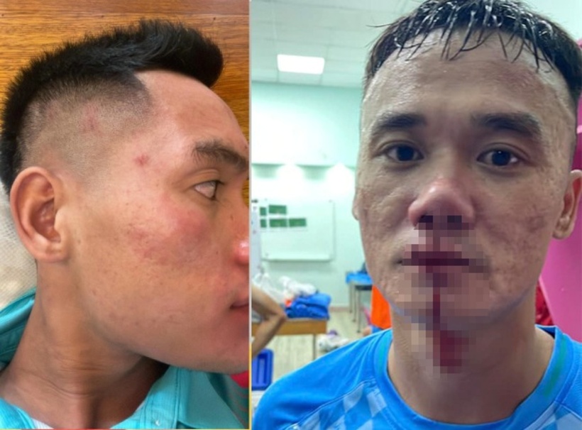 Cả Văn Sơn (trái) và Xuân Nam đều có thương tích. Ảnh: Người lao động