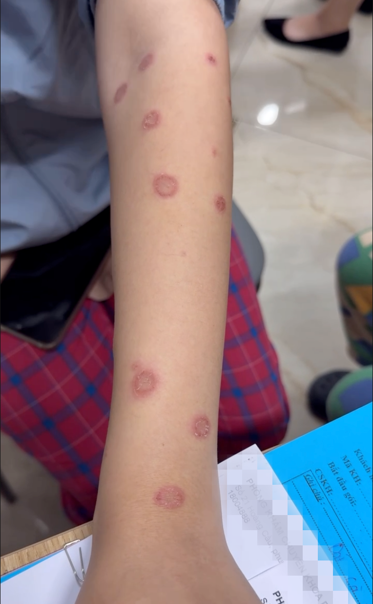 Sau 2 tuần nuôi mèo hoang, cả gia đình chị A xuất hiện các vết tổn thương trên da