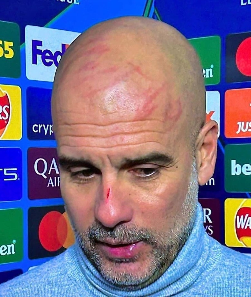 HLV Pep Guardiola tự cào rách mặt vì giận dữ