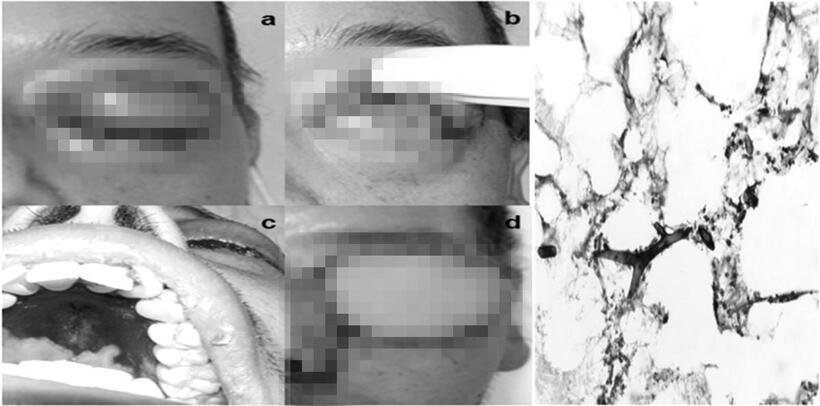 Một số hình ảnh tổn thương của bệnh nấm đen và hình ảnh sợi nấm đen. Ảnh minh họa