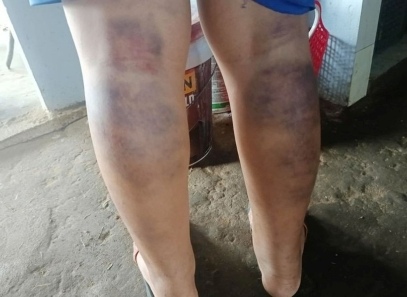 Nam sinh lớp 6 trường THCS Lê Quý Đôn bị cô chủ nhiệm đánh bầm tím 2 chân. Ảnh: Báo Tiền phong.