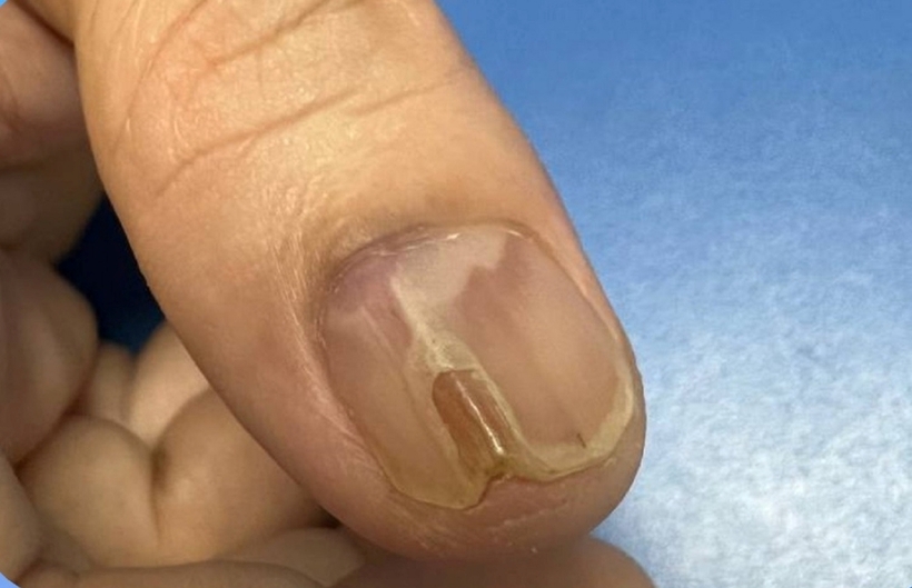 Bệnh nhân thấy đau nhức đầu ngón 1 bàn tay phải suốt 7 năm nay. Ảnh: Gia Đình Việt Nam