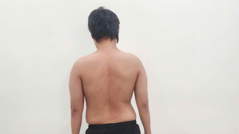Tập tạ khối lượng nặng khiến nam thanh niên lệch cột sống