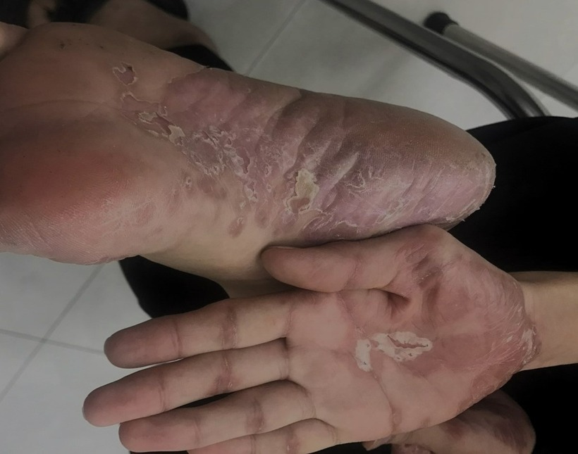 Người mắc bệnh giang mai mắt bị tổn thương da. Ảnh: ZNews