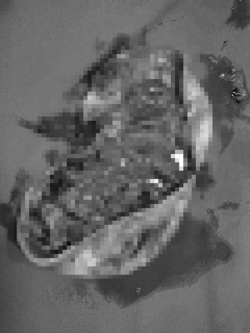 Các bác sĩ khuyến cáo người bệnh nên đi khám và điều trị sớm nếu có những dấu hiệu bất thường