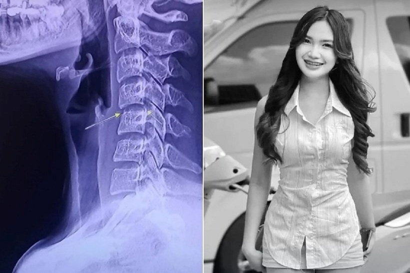 Nguyên nhân cái chết của Ping được xác định là nhiễm trùng máu và phù não, các biến chứng có thể liên quan đến chuỗi liệu pháp massage trước đó. Ảnh: The Nation