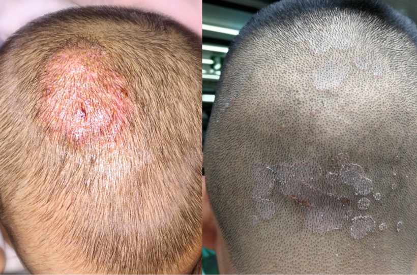 Trị gàu sai cách có thể dẫn tới nấm da đầu.