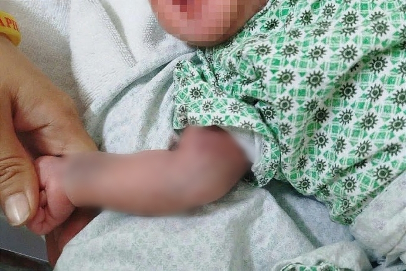 Ban xuất huyết rải rác ở tay của bé sơ sinh. Ảnh: Pháp Luật và Xã Hội