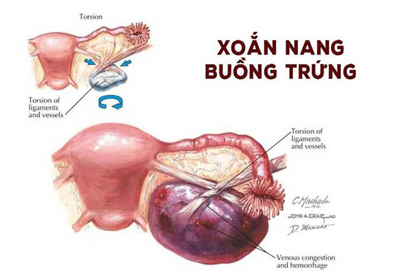 Xoắn u nang buồng trứng là tình trạng nghiêm trọng, người bệnh cần được điều trị càng sớm càng tốt