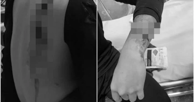 Cháu H. bị chém với nhiều thương tích trên cơ thể.