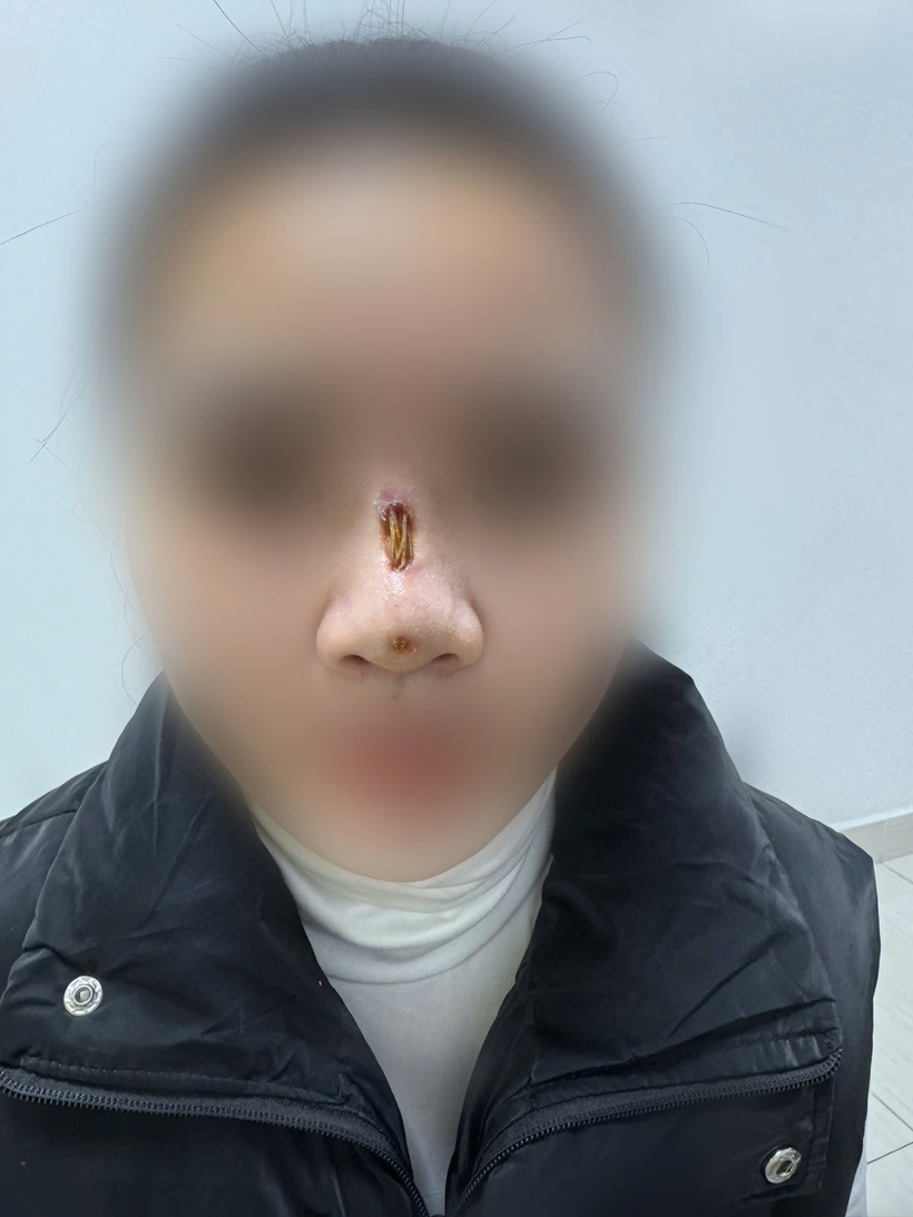 Cô gái trẻ bị thủng mũi sau căng chỉ nâng mũi 3 tháng tại cơ sở thẩm mỹ không rõ nguồn gốc. Ảnh: BVCC