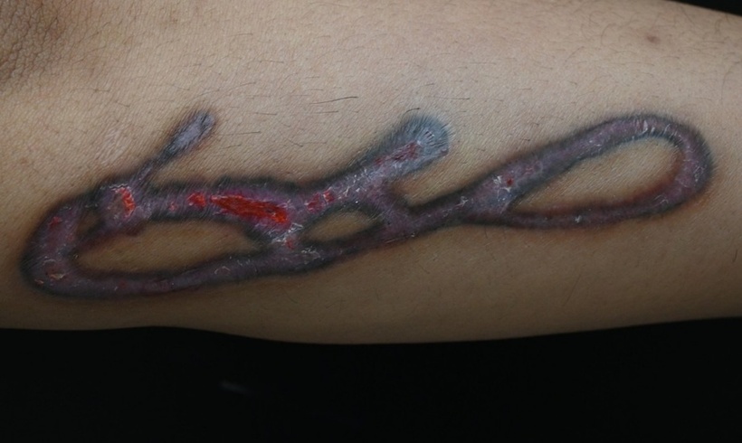 Bệnh nhân gặp phản vệ độ II do thuốc tê; nhiễm trùng da; nhiễm trùng huyết; tổn thương cơ tim do nhiễm trùng sau khi đi xóa xăm lưng. Ảnh minh họa