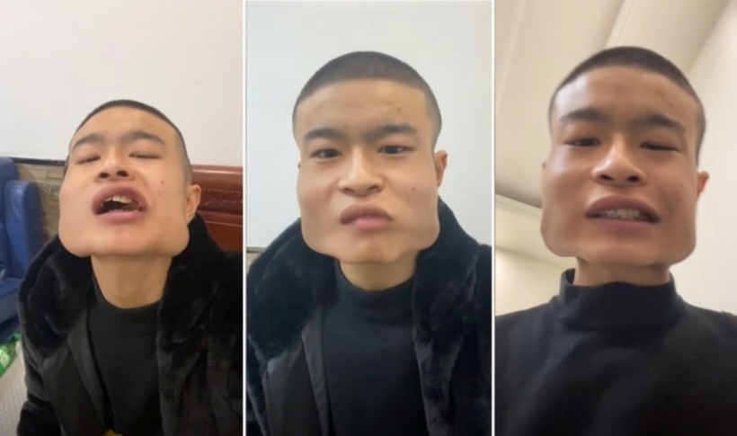 Chàng trai không giấu nổi sự hối hận khi thừa nhận sai lầm và cảnh báo mọi người nên tránh xa thói quen ăn trầu. Ảnh: SkyPost.
