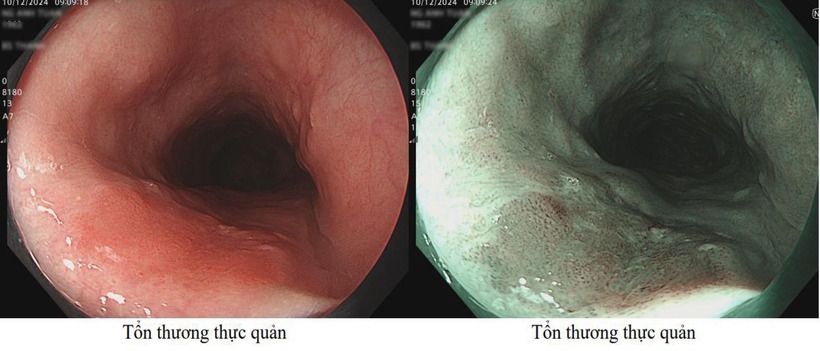 Tổn thương thực quản do thói quen hút thuốc lá. Ảnh: BSCC