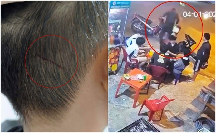 Bé Đ.N.A.K bị thương sau khi bị ông N.Đ.V. hành hung. (Ảnh: VTC News)