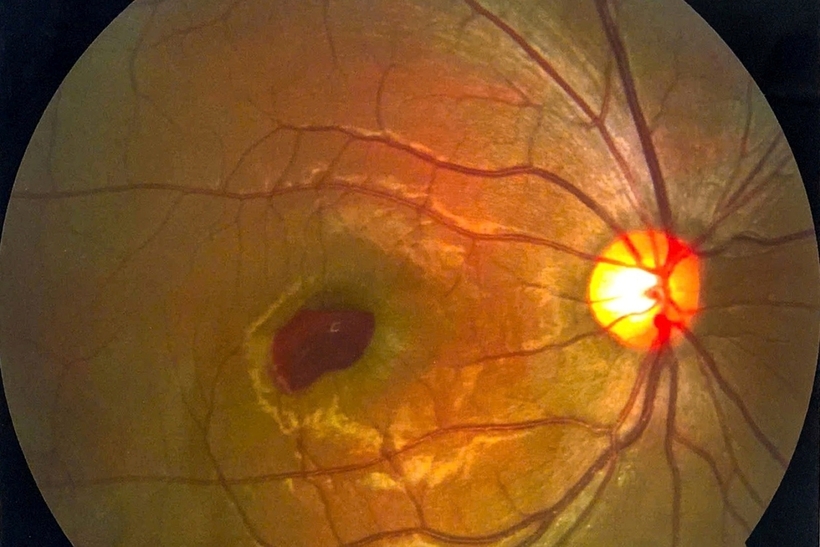 Tổn thương nặng trên mắt của người bệnh. Ảnh: Dân Trí