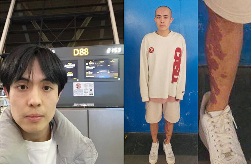 Vương Tinh trong bức ảnh do chính quyền Myanmar công bố, cho thấy anh bị cạo đầu. Vết đỏ lớn trên chân anh là vết bớt bẩm sinh. Ảnh: Khaosod.