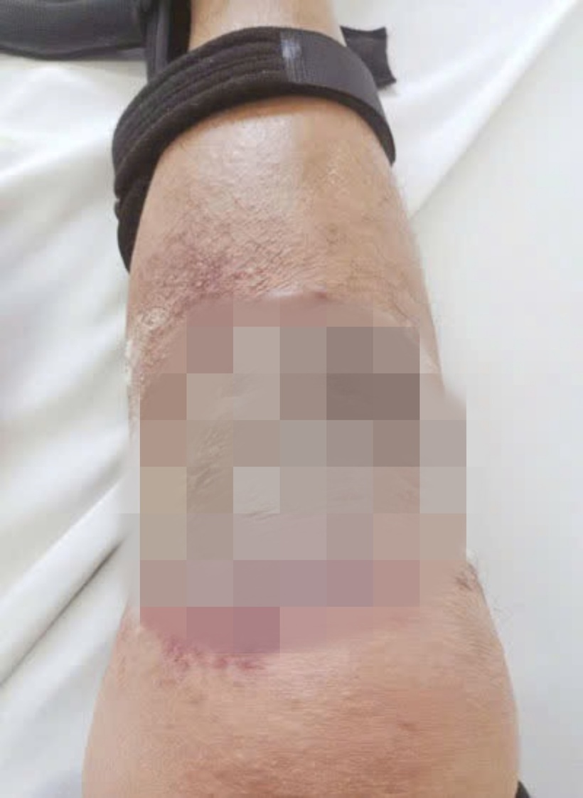 Chân của người đàn ông nhiễm trùng. Ảnh: Bệnh viện Việt Nam - Thụy Điển Uông Bí