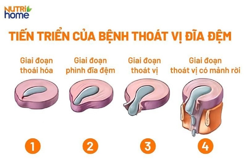 Các giai đoạn tiến triển của thoát vị đĩa đệm