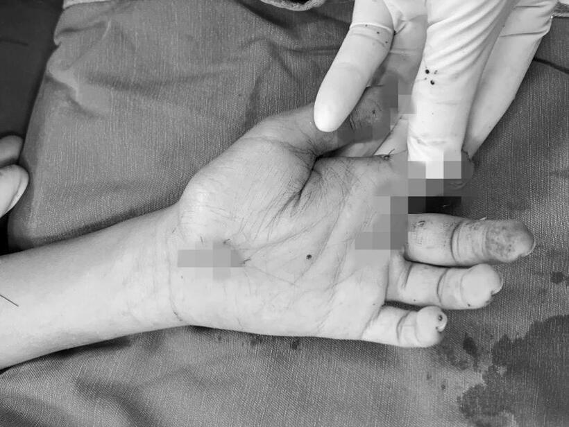 Trẻ ngay sau đó đã được xử trí cắt lọc phần bị dập, làm sạch vết thương, khâu vết thương hở. Ảnh: BVCC.