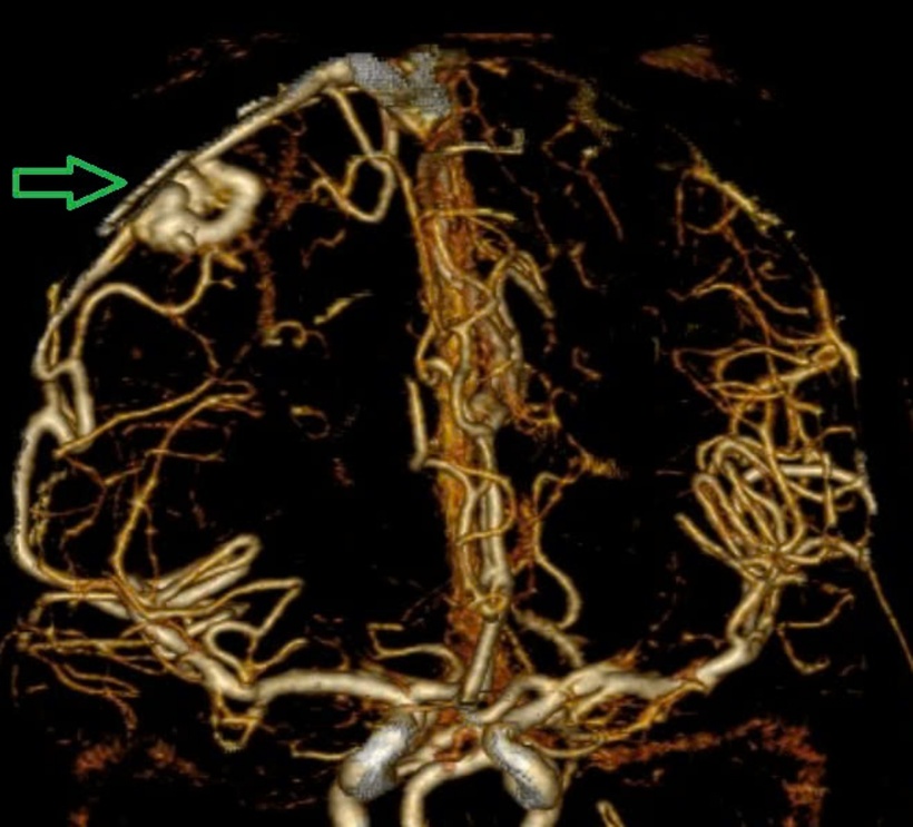 Hình ảnh chụp MSCT mạch não: Chảy máu não thuỳ đỉnh phải, chảy máu não thất do vỡ AVM ( điểm Spetzler Martin 2 điểm) bệnh nhân nữ, 29 tuổi. Ảnh: BVCC