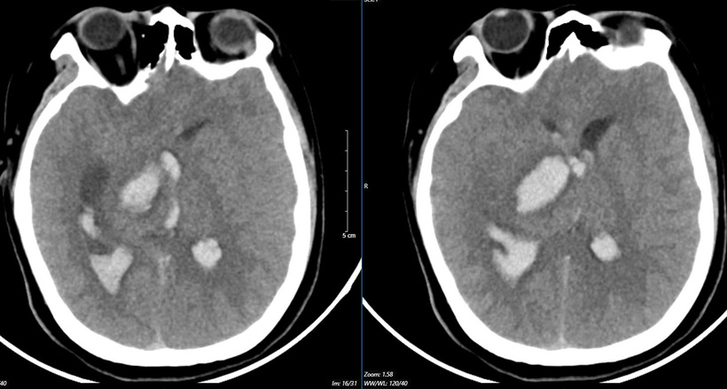 Hình ảnh chụp phim MSCT mạch não chảy máu não đồi thị - não thất do vỡ khối AVM (dị dạng thông động- tĩnh mạch não) bệnh nhân 15 tuổi. Ảnh: BVCC