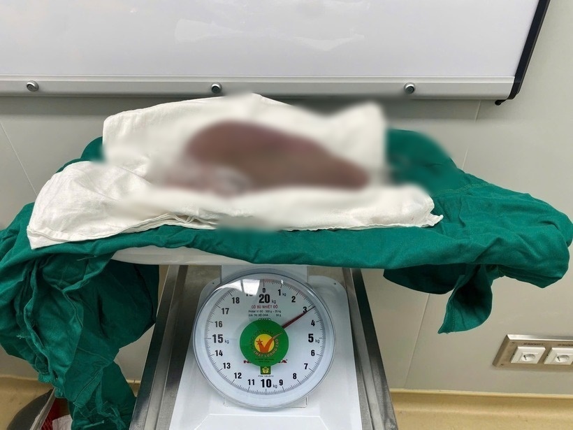 Khối u đã được bệnh nhân phát hiện từ 1 năm trước nhưng vì ngại ngần và chủ quan, nữ điều dưỡng để mặc khối u phát triển đến kích thước khổng lồ. Ảnh: BVCC