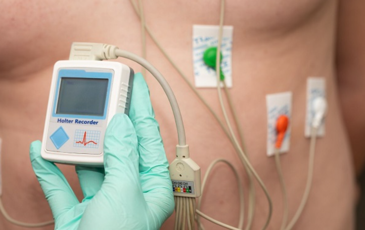 Đeo Holter monitor giúp theo dõi nhịp tim trong 24 giờ