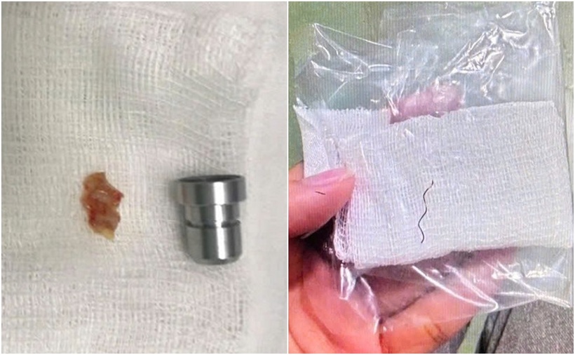 Dị vật là một mảnh xương cá và một sợi kẽm. (Ảnh: Bệnh viện)