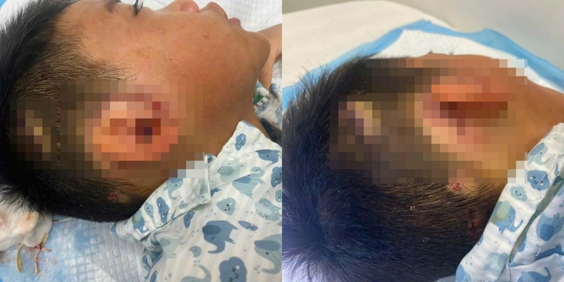 Bé trai hồi phục tốt sau phẫu thuật. Ảnh: BVCC