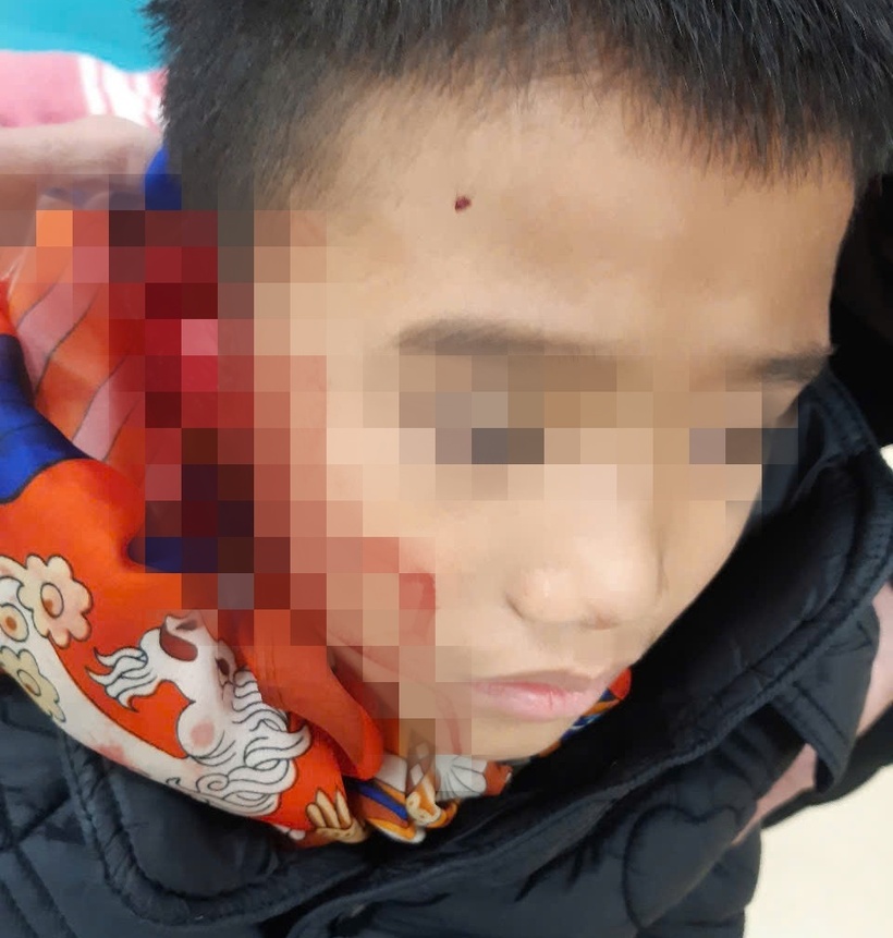 Bé trai bị chó nhà tấn công khiến vành tai gần đứt lìa. Ảnh: BVCC