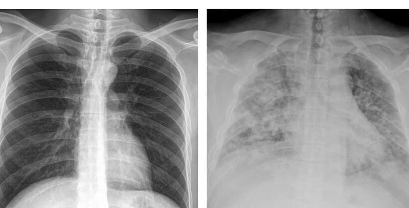 Ảnh chụp X-quang phổi của một bệnh nhân bị viêm phổi nặng do cúm. Ảnh: ETtoday.