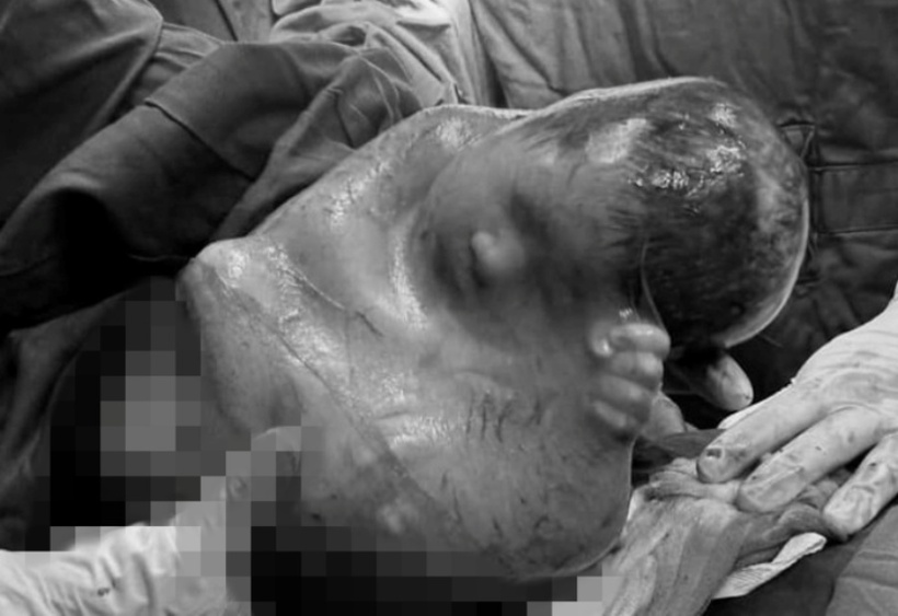 Em bé vẫn còn nguyên vẹn trong túi ối, hiện tượng dân gian gọi là "đẻ bọc điều". Ảnh: VnExpress.