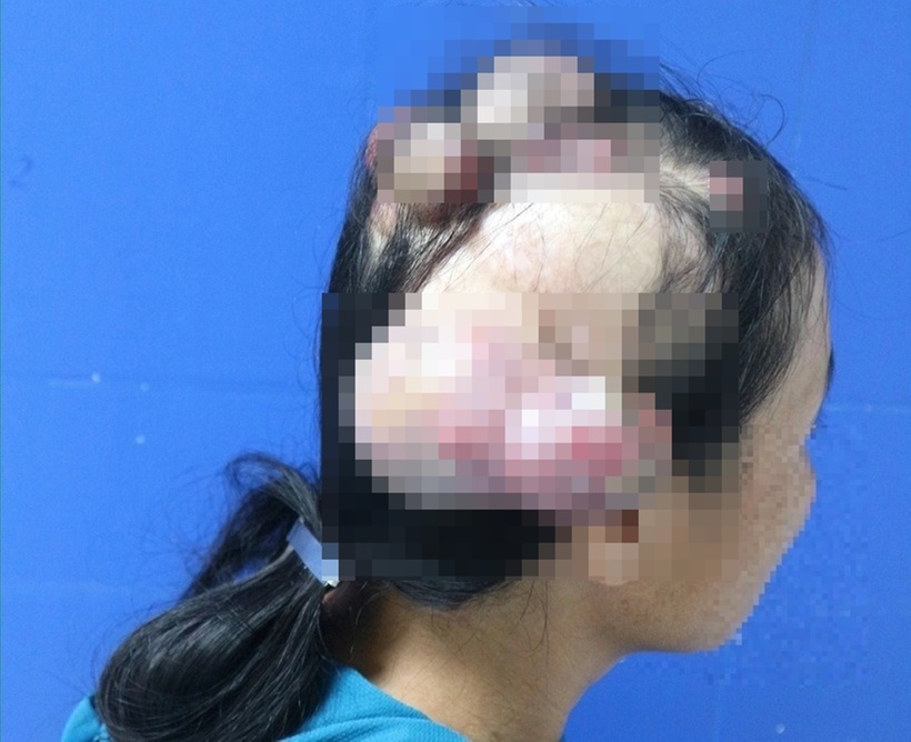Người phụ nữ mắc loại ung thư không phổ biến ở Việt Nam. Ảnh: BVCC