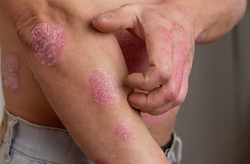 Chữa bệnh chàm á sừng bằng phương thuốc quý tại Bảo Thanh Đường - 1