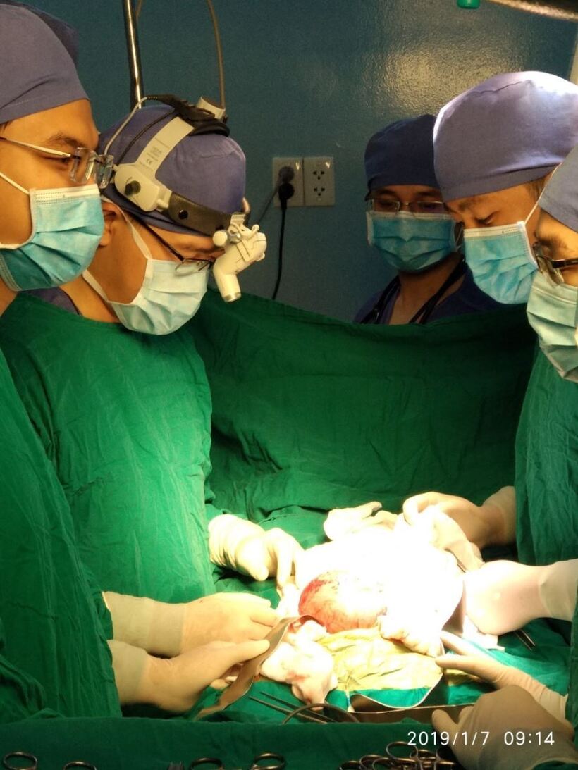 Các bác sĩ đã lấy ra một khối u nặng 1,5kg. Ảnh: Báo Tin Tức
