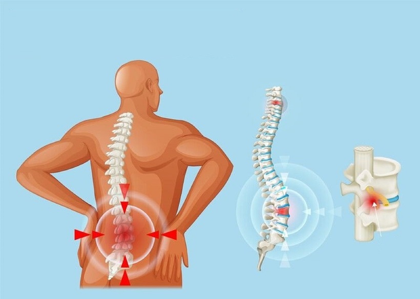 Thoát vị đĩa đệm là bệnh lý cột sống mãn tính