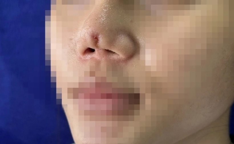 Chiếc mũi biến dạng của chị N..Ảnh: Dân Trí.