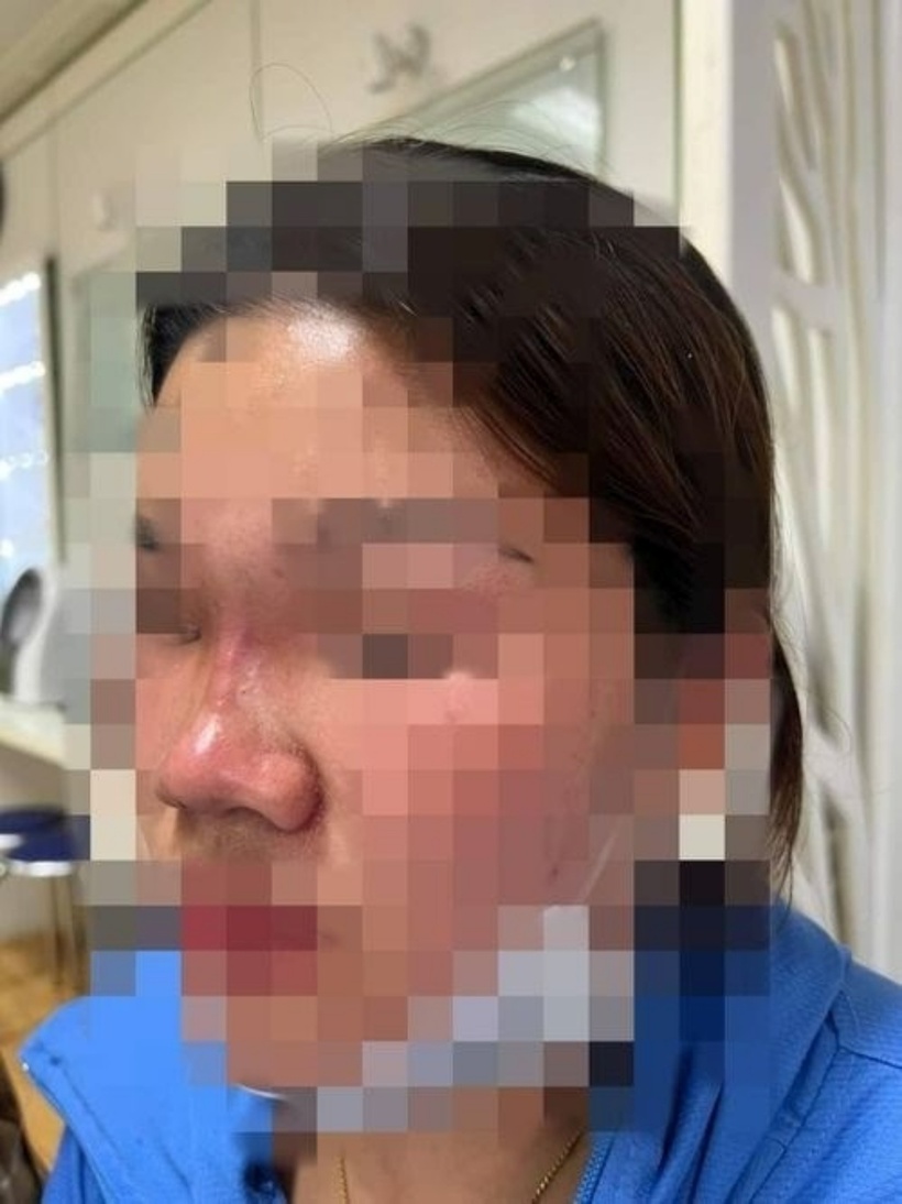 Chiếc mũi bị tai biến sau khi tiêm filler. Ảnh: Lao Động.
