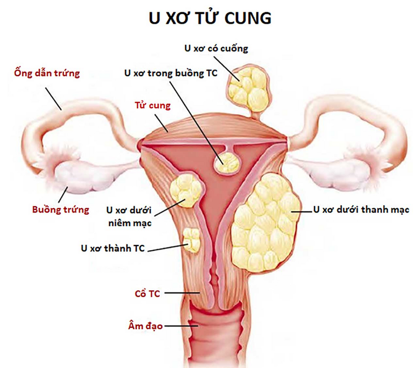 U xơ tử cung dưới thanh mạc là tình trạng khá phổ biến