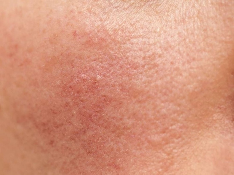 Rosacea là một tình trạng da phổ biến gây mẩn đỏ và thường đi kèm với những vết sưng nhỏ, đỏ có mủ hoặc nốt sần trên mặt. Nó có thể bị nhầm lẫn với mụn trứng cá do các triệu chứng tương tự. Ảnh minh hoạ.