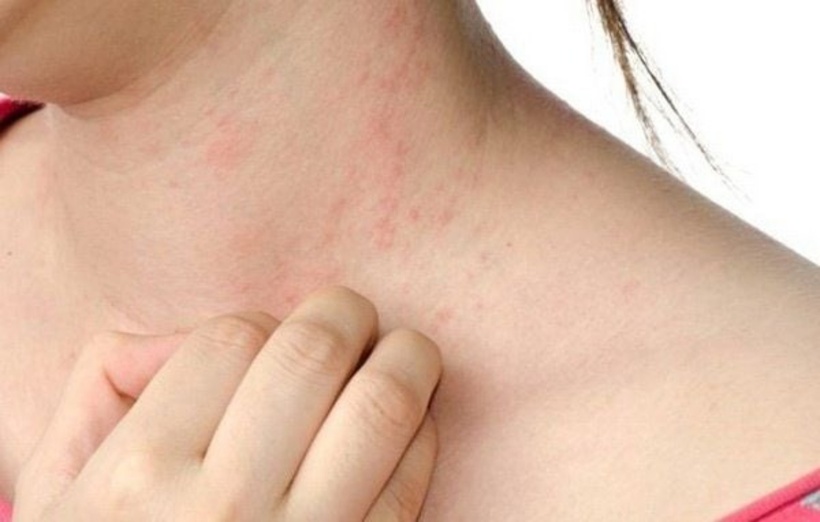Trong bệnh gan nhiễm mỡ, tình trạng viêm và tổn thương tế bào gan có thể làm gián đoạn dòng chảy của mật, dẫn đến tích tụ axit mật trong máu, có thể gây ngứa. Ảnh minh hoạ.