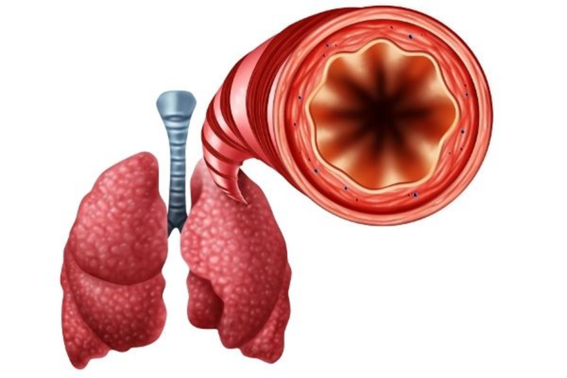 Viêm phế quản dạng hen khiến lòng phế quản bị thu hẹp tạm thời