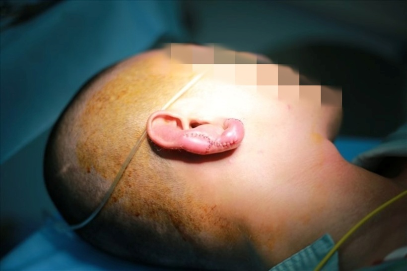 Tai bệnh nhân phải tạo hình lại. Ảnh: Lao Động.